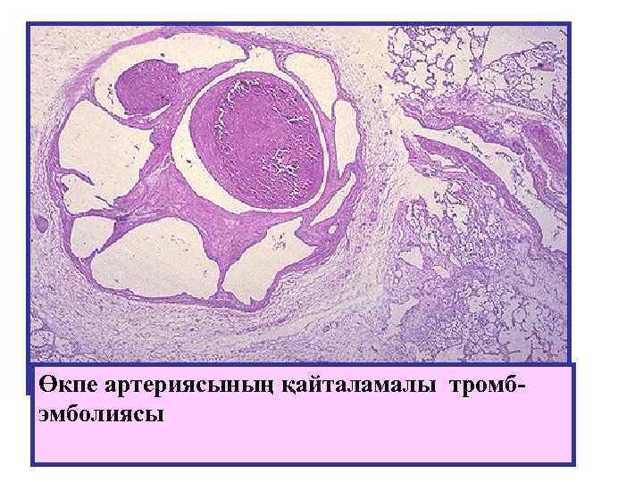 Өкпе артериясының қайталамалы тромбэмболиясы 