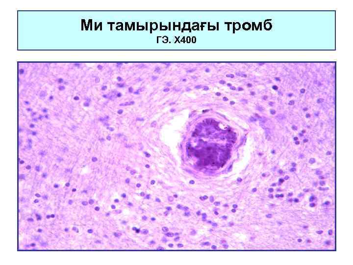 Ми тамырындағы тромб ГЭ. Х 400 