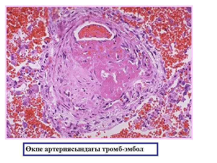 Өкпе артериясындағы тромб-эмбол 
