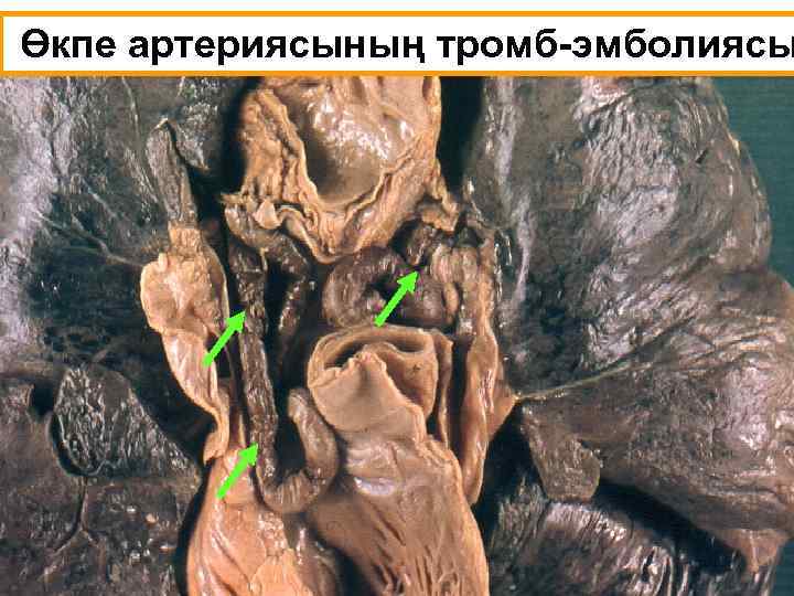 Өкпе артериясының тромб-эмболиясы 