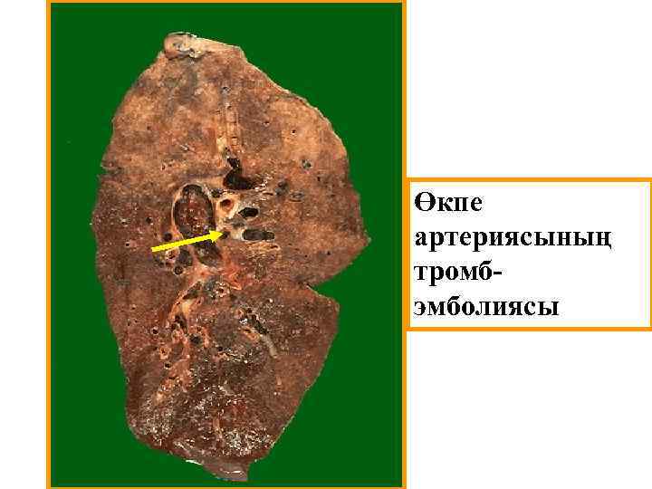 Өкпе артериясының тромбэмболиясы 