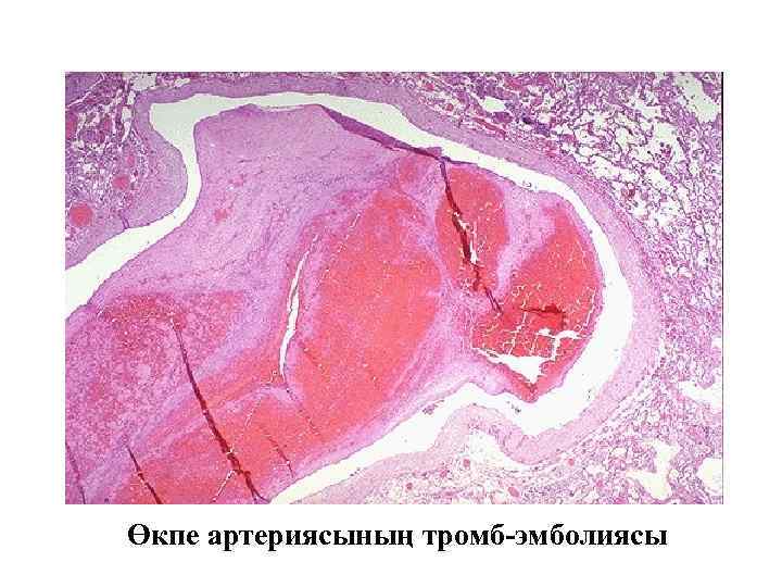 Өкпе артериясының тромб-эмболиясы 