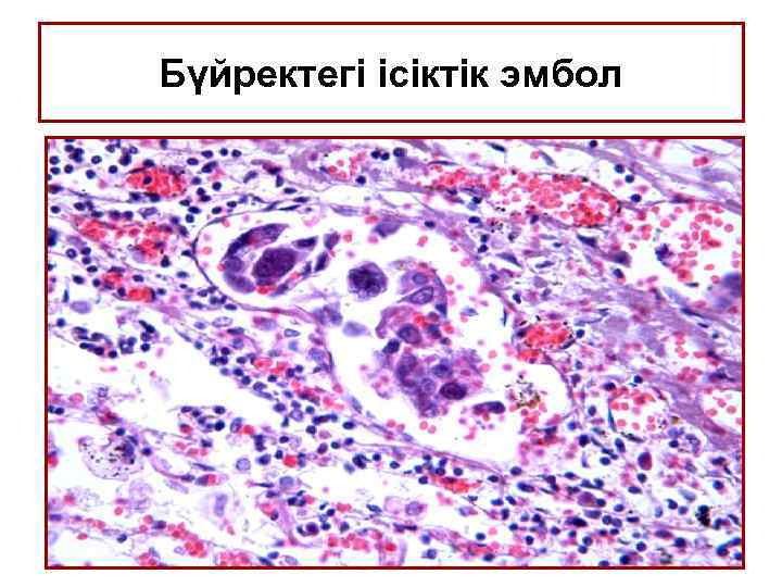 Бүйректегі ісіктік эмбол 