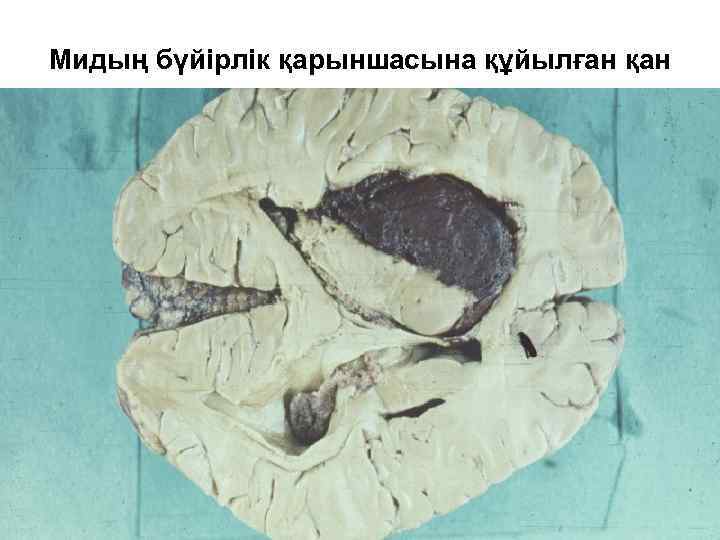 Мидың бүйірлік қарыншасына құйылған қан 