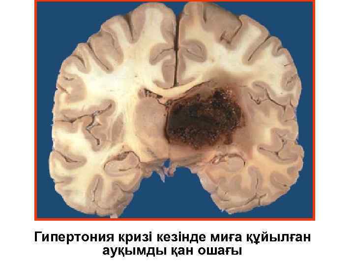 Гипертония кризі кезінде миға құйылған ауқымды қан ошағы 