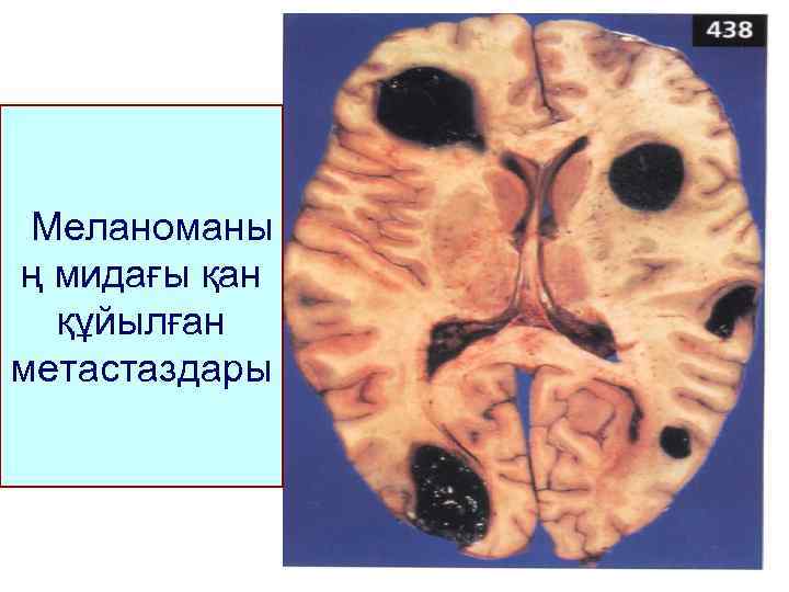 Меланоманы ң мидағы қан құйылған метастаздары 