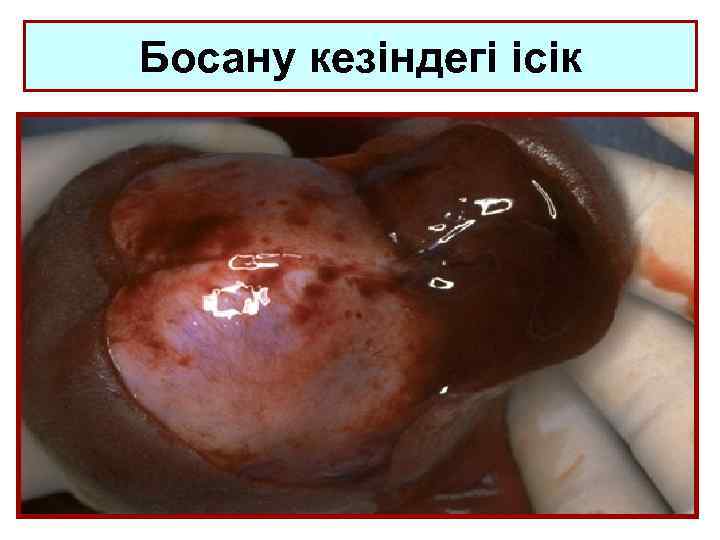 Босану кезіндегі ісік 
