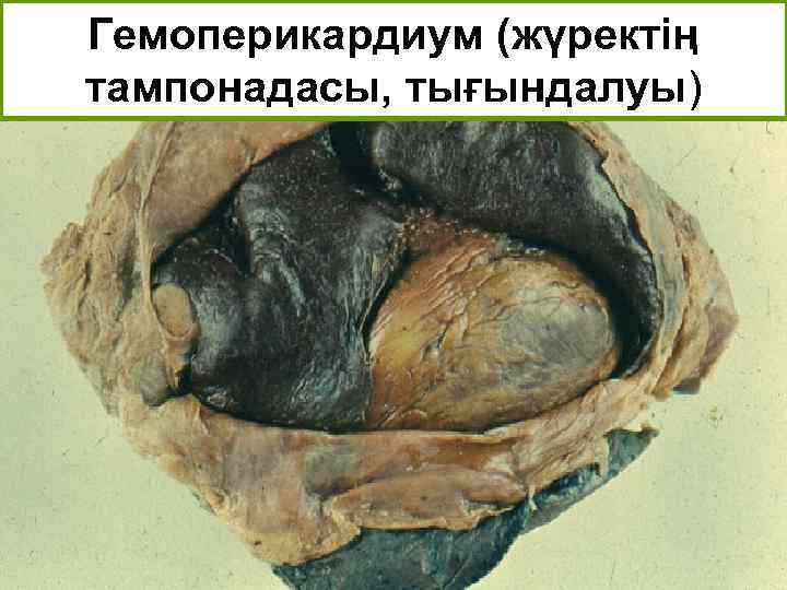 Гемоперикардиум (жүректің тампонадасы, тығындалуы) 