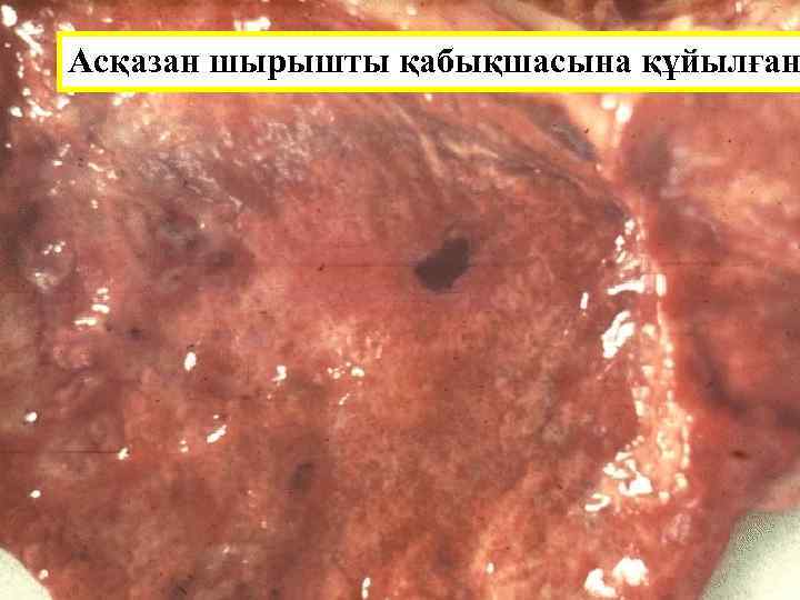 Асқазан шырышты қабықшасына құйылған 