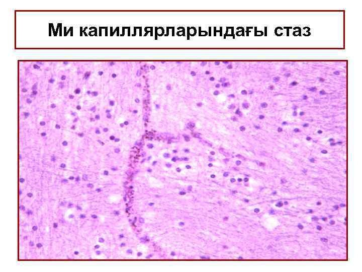 Ми капиллярларындағы стаз 