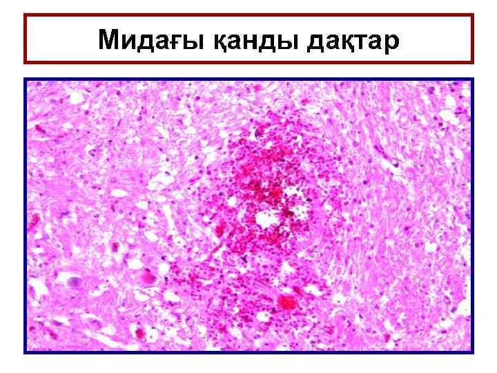 Мидағы қанды дақтар 