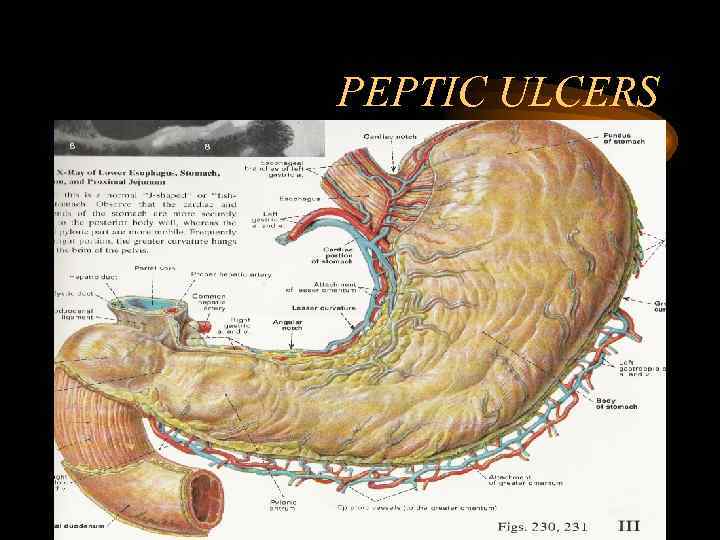 PEPTIC ULCERS 