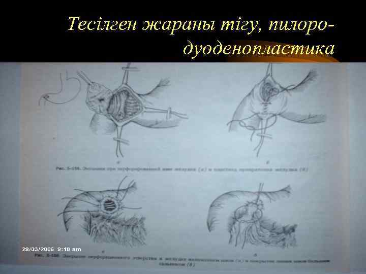 Тесілген жараны тігу, пилородуоденопластика 