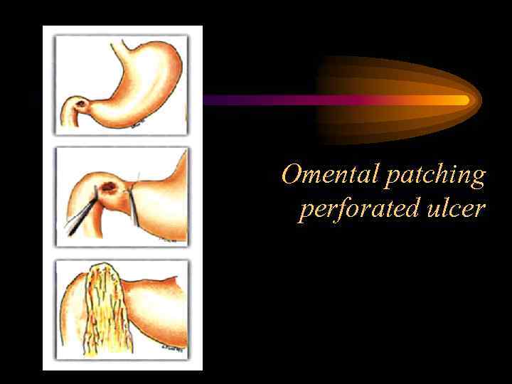 Omental patching perforated ulcer 