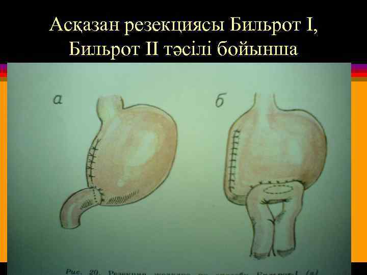 Асқазан резекциясы Бильрот I, Бильрот II тәсілі бойынша 