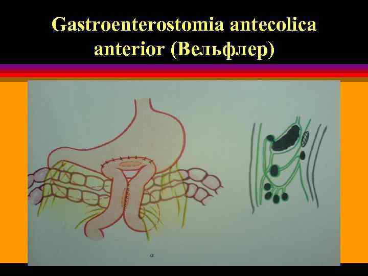 Gastroenterostomia antecolica anterior (Вельфлер) 