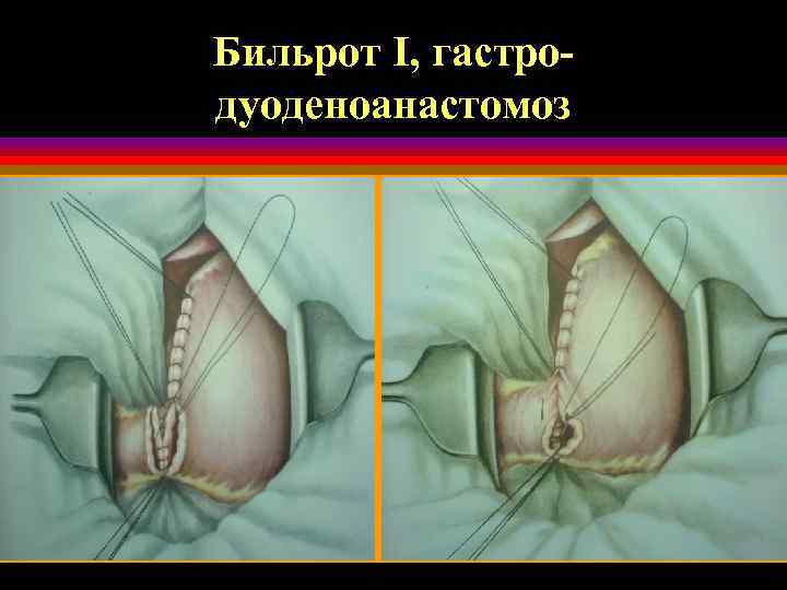 Бильрот I, гастродуоденоанастомоз 