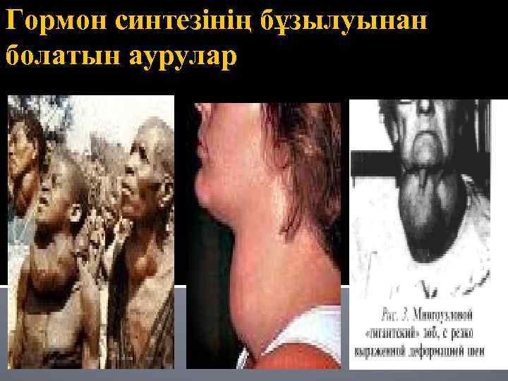 Гормон синтезінің бұзылуынан болатын аурулар 