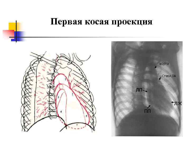 Первая косая проекция аорта Ствол ЛА ЛП ЛЖ ПП 