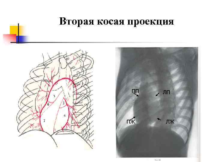 Вторая косая проекция ПП ПЖ ЛП ЛЖ 