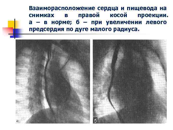 Схема рентгенограммы контрастированного пищевода