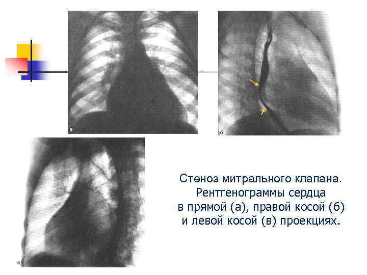 Стеноз митрального клапана. Рентгенограммы сердца в прямой (а), правой косой (б) и левой косой