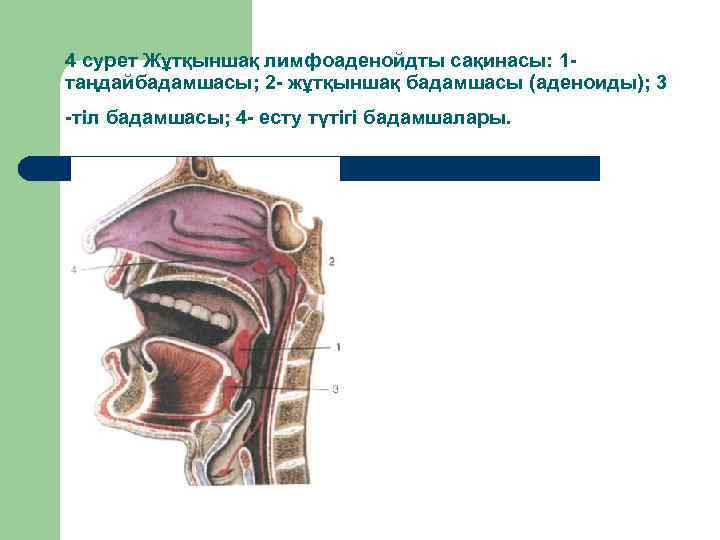 4 сурет Жұтқыншақ лимфоаденойдты сақинасы: 1 таңдайбадамшасы; 2 - жұтқыншақ бадамшасы (аденоиды); 3 -тіл