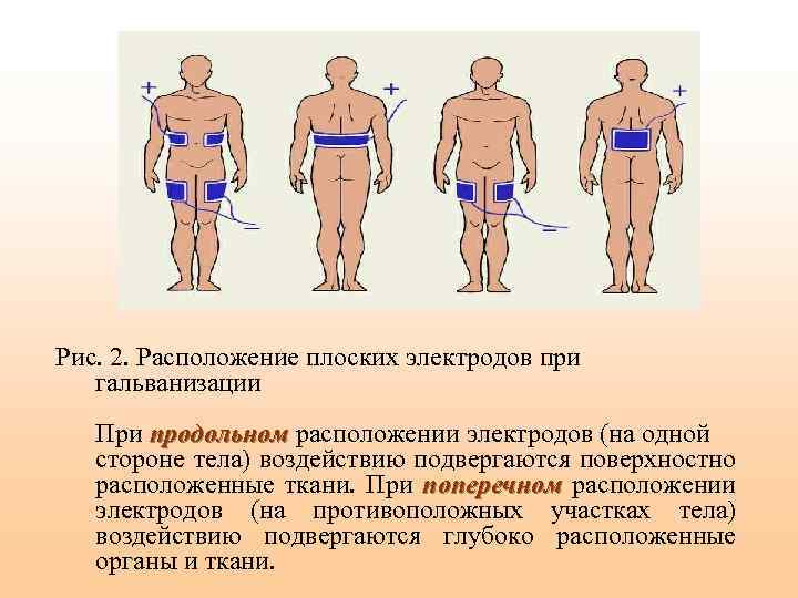  Рис. 2. Расположение плоских электродов при гальванизации При продольном расположении электродов (на одной