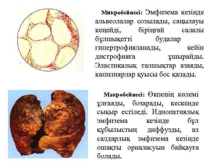 Эмфизема кезінде альвеолалар созылады, саңылауы кеңейді, біріңғай салалы бұлшықетті будалар гипертрофияланады, кейін дистрофияға ұшырайды.