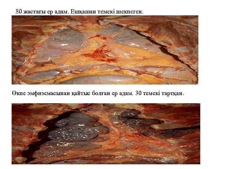 80 жастағы ер адам. Ешқашан темекі шекпеген. Өкпе эмфиземасынан қайтыс болған ер адам. 30