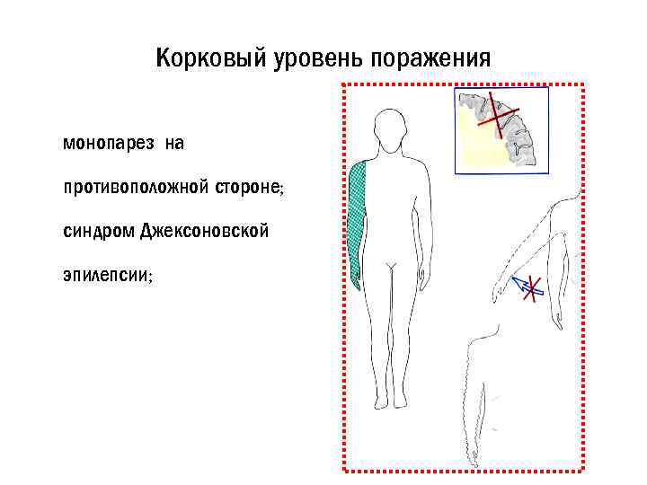 Корковый уровень поражения монопарез на противоположной стороне; синдром Джексоновской эпилепсии; 