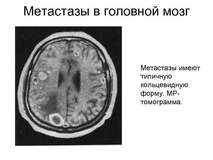 Метастазы в мозгу форум. Метастазы в головном мозге. Метастазированием в головной мозг.