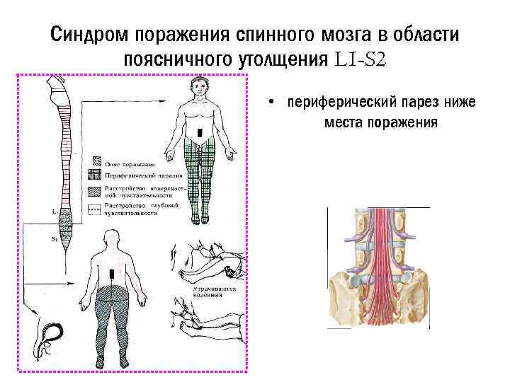 Синдром поражения спинного мозга в области поясничного утолщения L 1 -S 2 • периферический