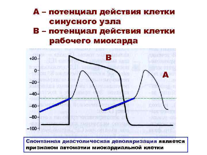 А – потенциал действия клетки синусного узла В – потенциал действия клетки рабочего миокарда