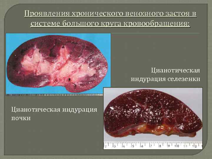 Проявления хронического венозного застоя в системе большого круга кровообращения: Цианотическая индурация селезенки Цианотическая индурация