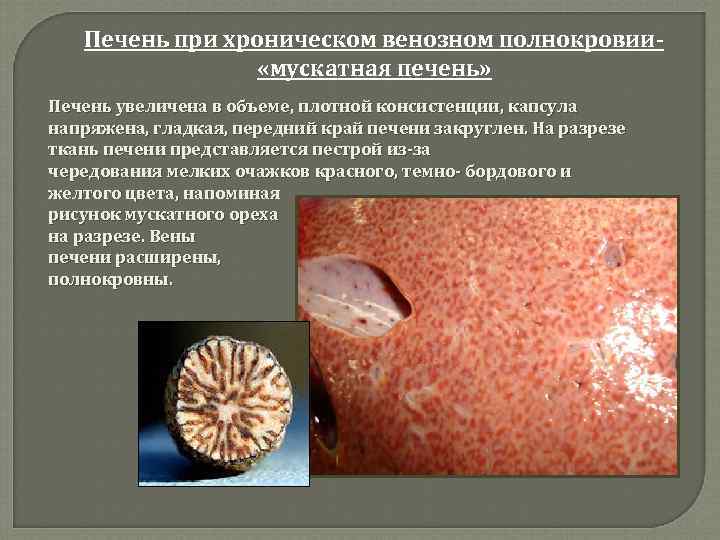 Печень при хроническом венозном полнокровии «мускатная печень» Печень увеличена в объеме, плотной консистенции, капсула
