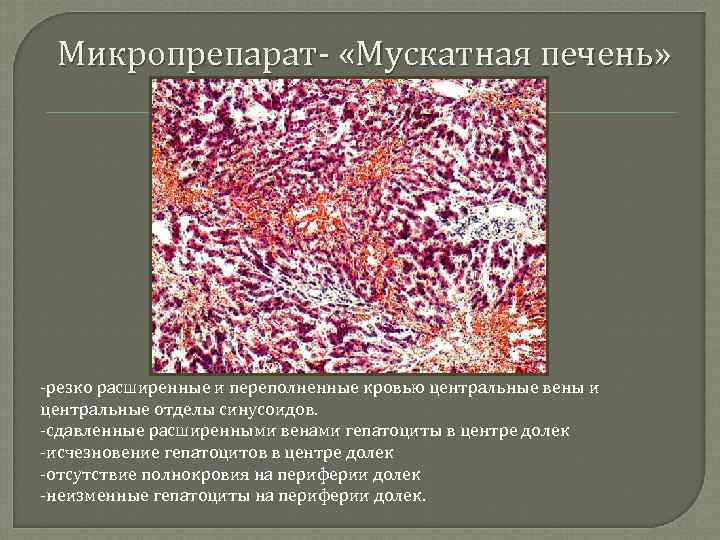 Микропрепарат- «Мускатная печень» -резко расширенные и переполненные кровью центральные вены и центральные отделы синусоидов.