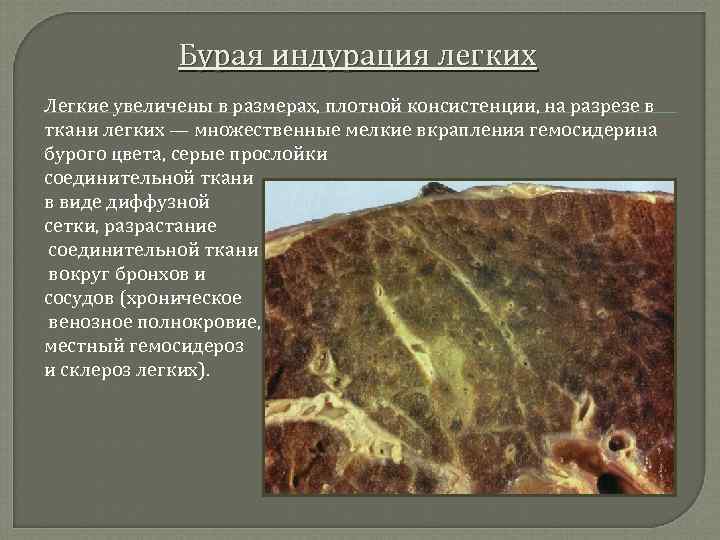 Бурая индурация легких Легкие увеличены в размерах, плотной консистенции, на разрезе в ткани легких