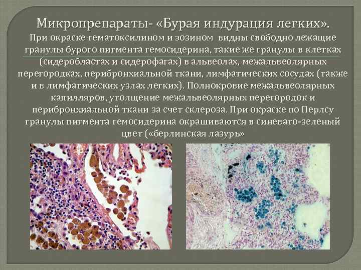 Микропрепараты- «Бурая индурация легких» . При окраске гематоксилином и эозином видны свободно лежащие гранулы