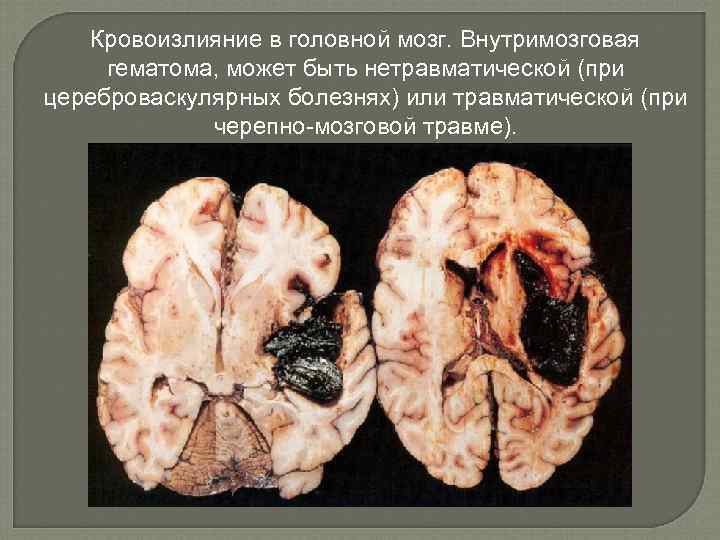 Кровоизлияние в головной мозг. Внутримозговая гематома, может быть нетравматической (при цереброваскулярных болезнях) или травматической