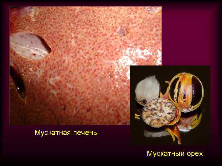 Мускатная печень Мускатный орех 