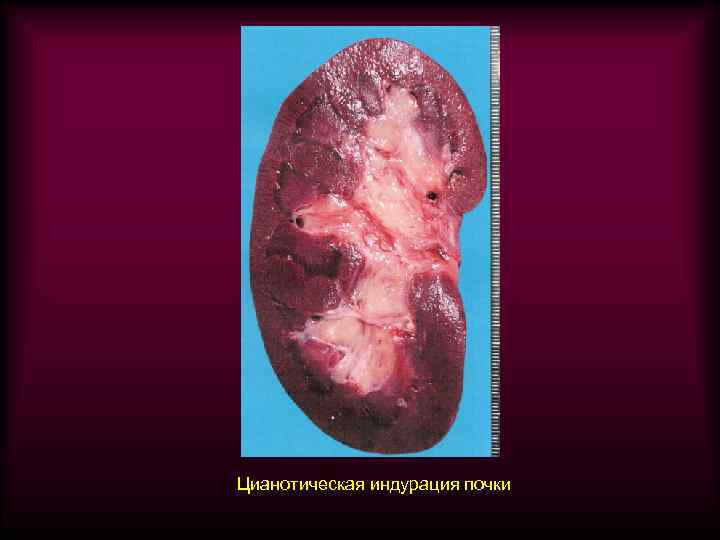 Цианотическая индурация почки 