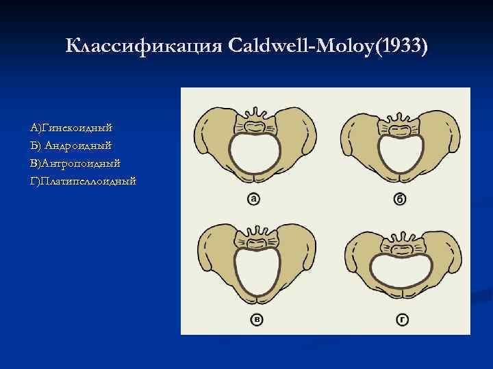 Классификация Caldwell-Moloy(1933) А)Гинекоидный Б) Андроидный В)Антропоидный Г)Платипеллоидный 
