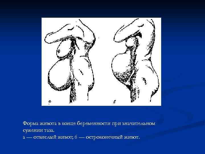 Форма живота в конце беременности при значительном сужении таза. а — отвислый живот; 6