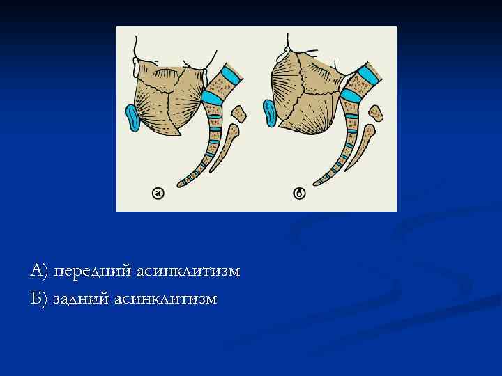 А) передний асинклитизм Б) задний асинклитизм 