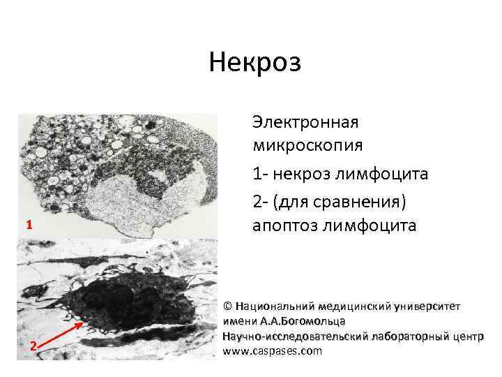 Некроз 1 2 Электронная микроскопия 1 - некроз лимфоцита 2 - (для сравнения) апоптоз