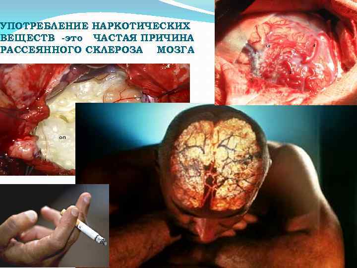 УПОТРЕБЛЕНИЕ НАРКОТИЧЕСКИХ ВЕЩЕСТВ -это ЧАСТАЯ ПРИЧИНА РАССЕЯННОГО СКЛЕРОЗА МОЗГА 