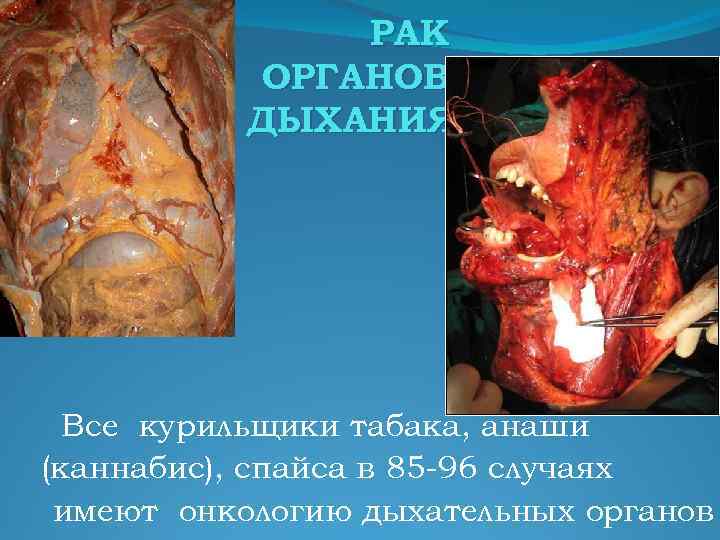 РАК ОРГАНОВ ДЫХАНИЯ Все курильщики табака, анаши (каннабис), спайса в 85 -96 случаях имеют