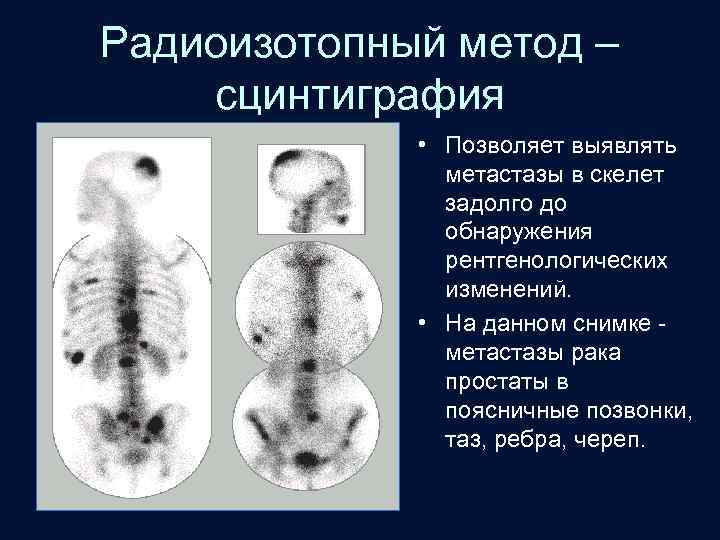 Радиоизотопный метод – сцинтиграфия • Позволяет выявлять метастазы в скелет задолго до обнаружения рентгенологических