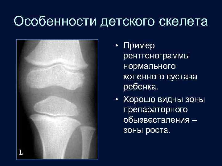 Особенности детского скелета • Пример рентгенограммы нормального коленного сустава ребенка. • Хорошо видны зоны